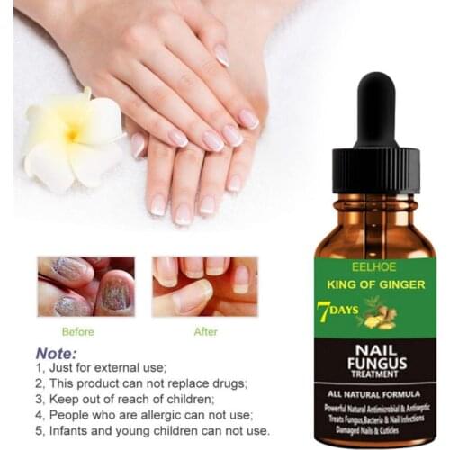 50/30/20/10ml Ginger Liquid Nail Fungal Treatment Fluid Solution Anti Fungus Toenail Growth Repair Fluid Nail Toe Care NEW TSLM1