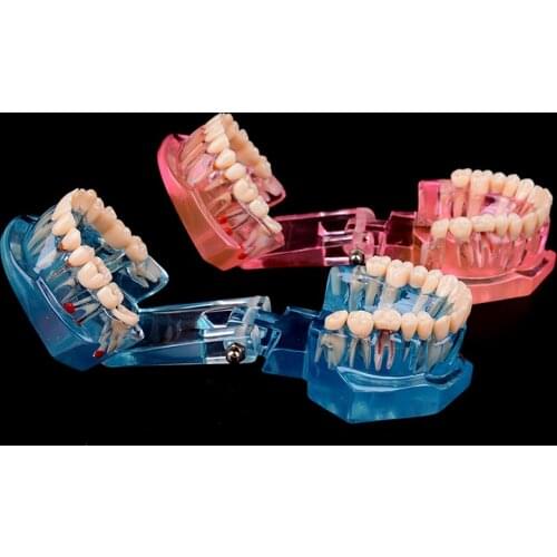 New Dental Implant Disease Teeth Model With Restoration Bridge Tooth Dentist For Medical Science Dental Disease Teaching Study