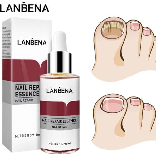 LANBENA Fungal Nail Treatment Essence Toe Repair Serum Fungus Removal Anti Infection Paronychia Onychomycosis Hand Foot Care