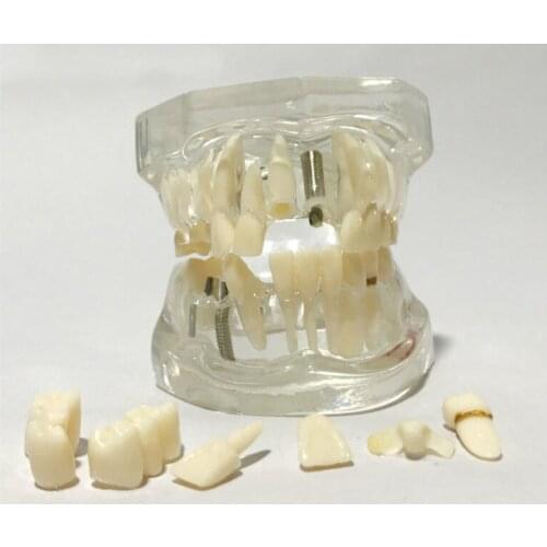 Transparent 1:1 Life Size Detachable Human Teeth Model Pathological Teeth Model Oral Dental Model Human Dental Anatomy