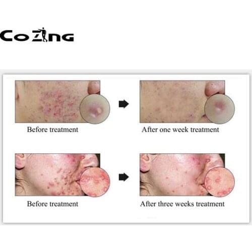 Back Pain Therapy Apparatus LED Device Beauty Photon Rejuvenation Instrument Phototherapy Acne Electronic Beauty Machine