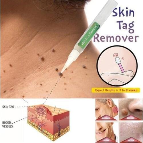 Skin Tag Remover Pen Genital Wart Treatment Papillomas Removal Foot Corn Care Tool Against Moles Dark Spot Remover Liquid