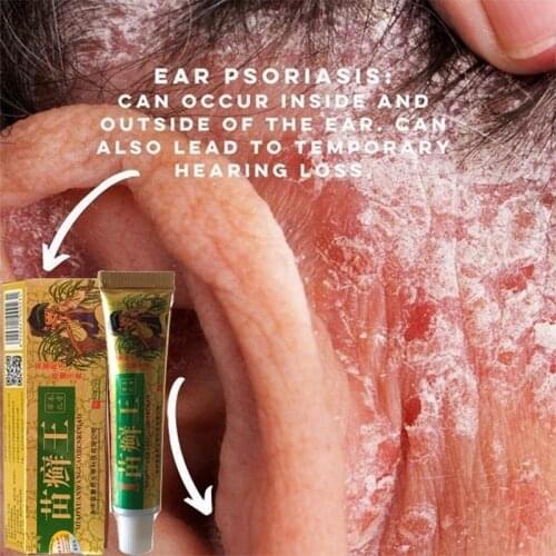 1Pc Health Care Skin Fungus Anti Bacterial Cream Natural Chinese Herbs Cream Onitment for Psoriasis Dermatitis Eczema Treatment