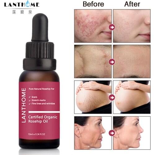 10ML Pure Organic Rosehip Oil Antioxidantfor Scars Fine Lines Wrinkles Stretch Marks Improve Skin Elasticity Firmness