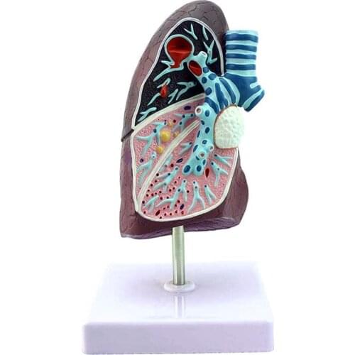 Human Pathological Lung Model Human Anatomical Lung Pathology Anatomy Medical Model Simulation Respiratory System Model