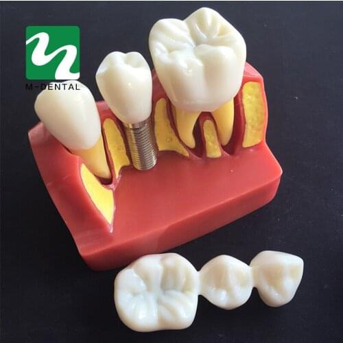 1 PC 4-times Planting Teeth Model Oral Teaching Model Dental Pathology Model For Dentistry Lab