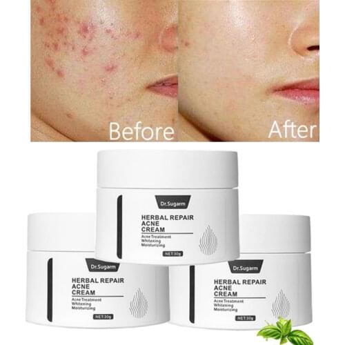 Acne Treatment Face Cream Blackhead Repair Gel Oil Control Shrink Pores Scar Whitening Moisturizer Skin Care Korean Cosmetics