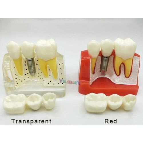 1Pc Dental Teach Implant Analysis Crown Bridge Removable Model Dental Demonstration Teeth Model