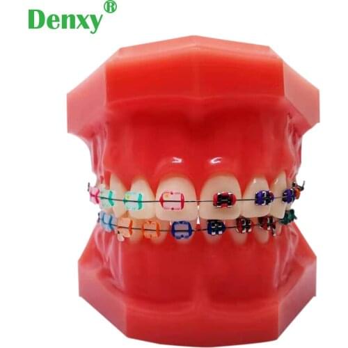 Denxy Dental Orthodontic Model Typodont With Ortho Metal Ceramic Bracket Arch Wire Buccal Tube Ligature Tie Medical Education