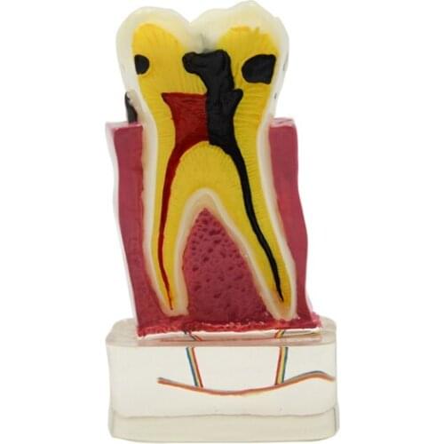 4:1 Dentist Dental Study Teach Tooth Model Teeth Disease Model DEASIN