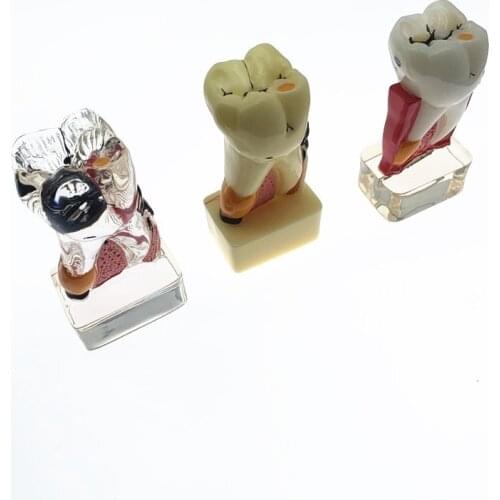 Teeth Model 4 times tooth pathology model Comprehensive Periodontal Model for dental teaching and research models