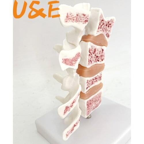 Osteoporosis Model Spine Pathological Model Human Spine Model Human Anatomy Skeleton Vertebrae Disease Medical Teaching Supply