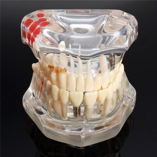 Dental Disease Teeth Model With Restoration Bridge Tooth Dentist For Medical Science Dental Disease Teaching Model Study Tool