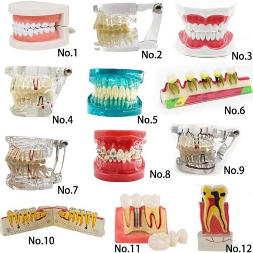 Tooth Teaching Model, Doctor-patient Communication Model For Implant Surgery, Dental Restoration, Caries, Tooth Brushing 1 Piece