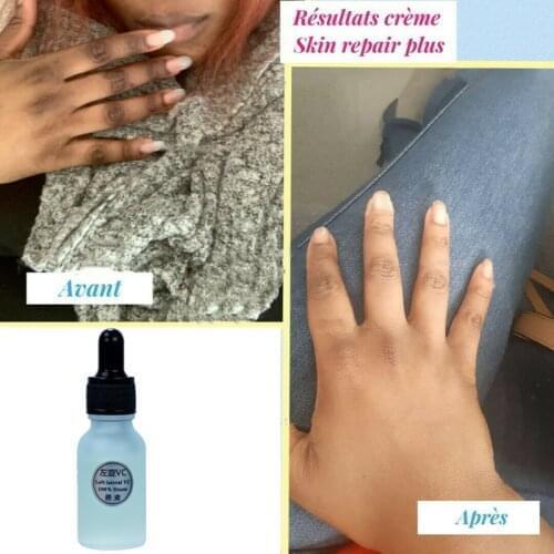 Corrective skin-lightening cream for hyperpigmentation for hands, feet