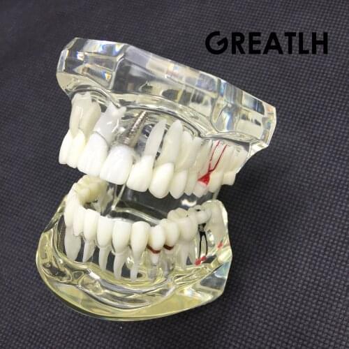 Dental Implant Disease Teeth Model With Restoration Bridge Tooth Dentist For Science Dental Disease Teaching Study