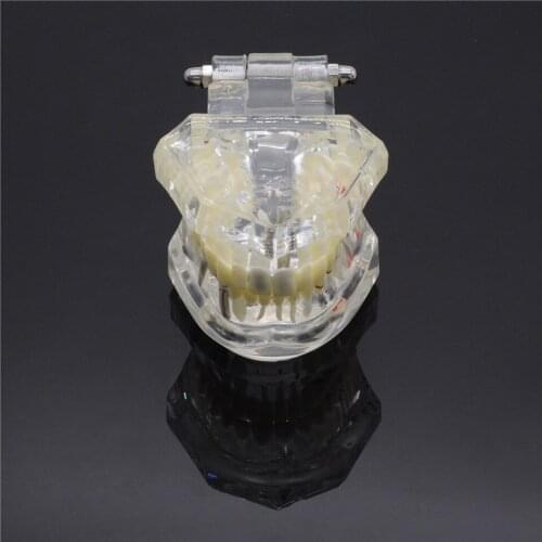 1 Piece Dental Adult Disease Implant Tooth Pathological Teeth Dismountable Model