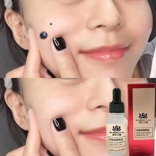 20ml Remove Mole Essential Oil Painless Free Potion Repair Face Wart Tag Freckle Skin Care Essential Oil