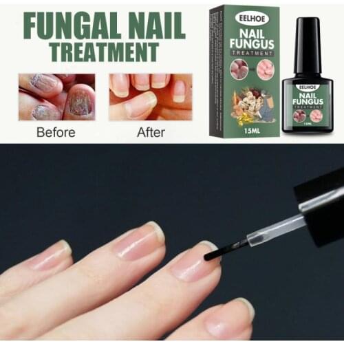 Nail Fungal Cure Nail Fungus Removal Liquid Nutritious Anti Paronychia Onychomycosis Foot Repair Fungal Nail Repair TSLM1