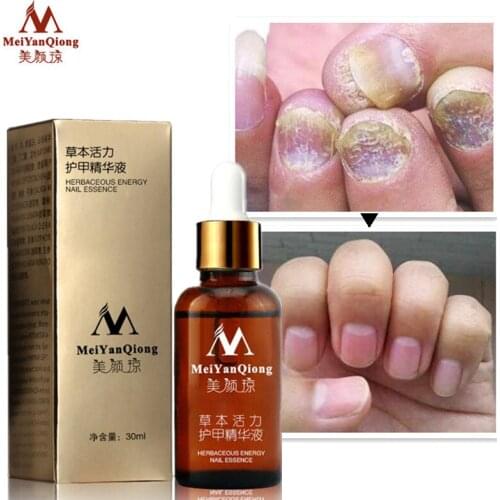 5Pcs/Lot Fungal Nail Treatment Essence Nail and Foot Whitening Toe Nail Fungus Removal Feet Nail Care Essential Oil