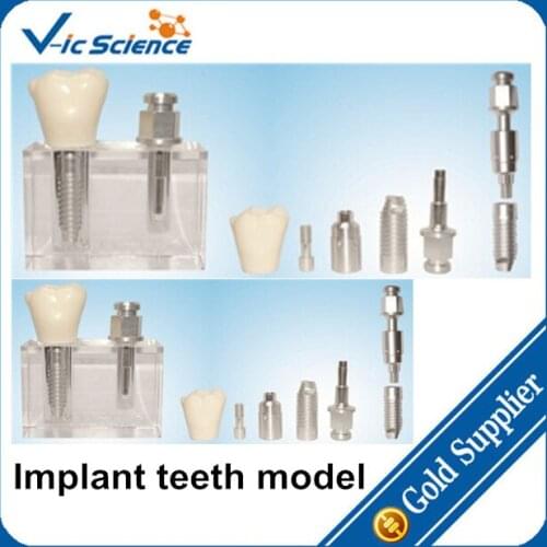 Transparent Implant Teeth Model/Implant Model/Teeth Model