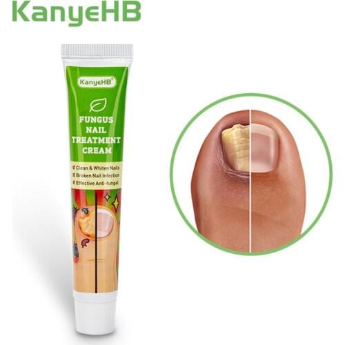 1pcs Nail Fungal Treatment Cream Nail Whitening Toe Nail Fungus Removal Ointment Anti Infection Paronychia Onychomycosis G004