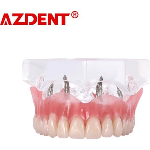Dental Overdenture Teeth Dental Implant Teeth Model Demo Overdenture Restoration With Implants upper