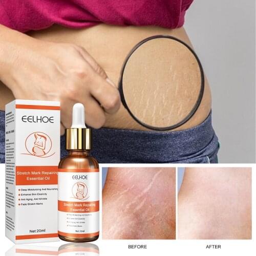 Images Cream For Stretch Marks China