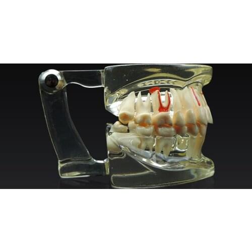 1pc Denatl Teaching Adult Disease Teeth Model Detachable Pathological Model Restoration Bridge Dentist Training Use Oral Teeth