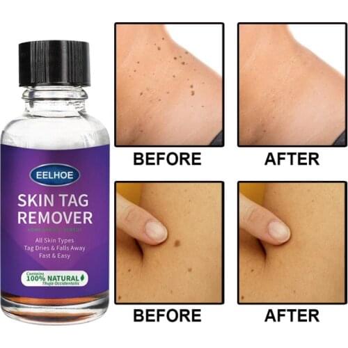 10/20/30/50ml Mole & Skin Tag Removal Solution Painless Mole Skin Dark Spot Removal Face Wart Tag Removal Removal Cream TSLM1