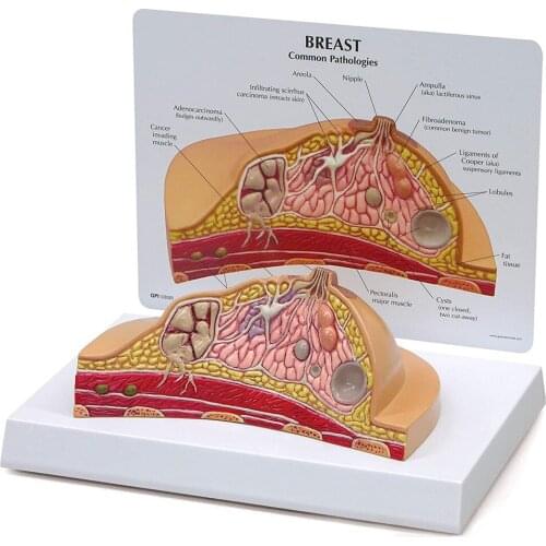 Female Breast Structure Anatomical Model Disease Cancer Pathological Breast Anatomy Model Medical Education and Training