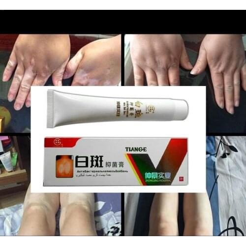 White Spot Antibacterial Cream Chinese Medical Pigment Vitiligo Disease Treatment Skin Leukoplakia Melanin Care Promoting H L6P9