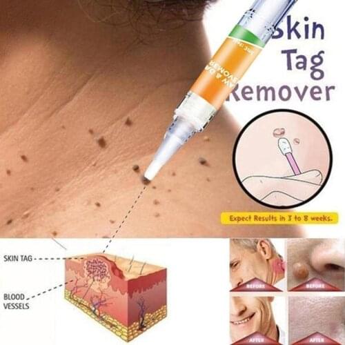 Skin Tag Remover Herbal Extract Foot Corn Plaster Warts Ointment Warts Remover Antibacterial Ointment Wart Treatment Cream