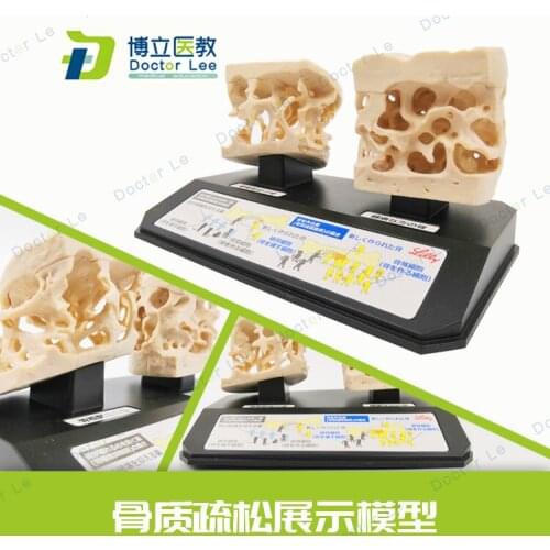 Human Spinal Femoral Osteoporosis Demonstration Model