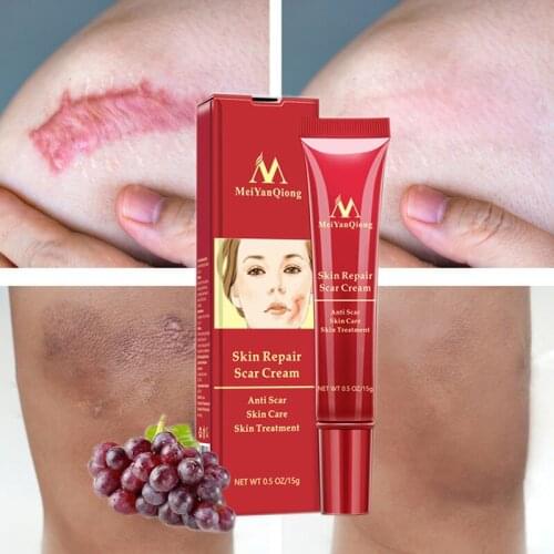 MeiYanQiong Acne Scar Cream Skin Repairing Whitening Cream Acne-Treatment Fade Deark Spots Old Scars Stretch Marks Brightening