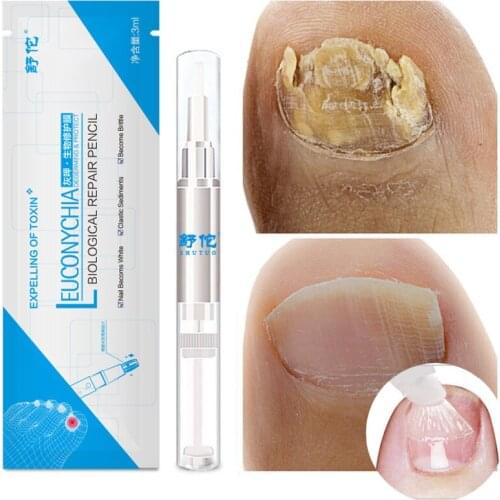 Nail Fungal Treatment Feet Care Essence Nail Foot Toe Nail Fungus Removal Gel Anti Infection Paronychia Onychomycosis 3ml