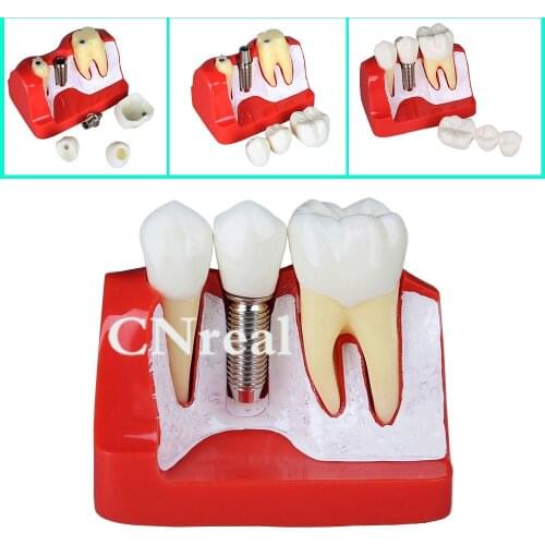 1 Piece Dental Implant Analysis Crown Bridge Demonstration Teeth Model