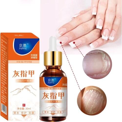 Nail Fungal Treatment Feet Care Essence Nail Foot Whitening Toe Nail Fungus Removal Gel Anti Infection Paronychia Onychomycosis