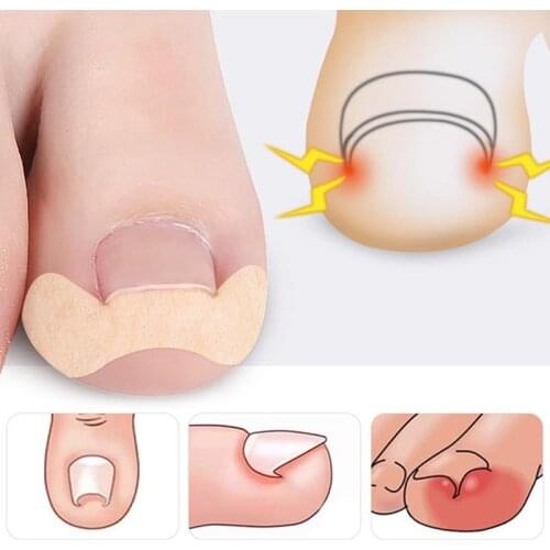 4/5/10/20/50Pcs/lot Non-woven Fabric Toenail Corrector Ingrown Toe Foot Nail Correction Patch Nail Sticker