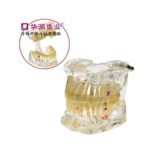 Dental teaching model Adult pathology teeth model free shipping