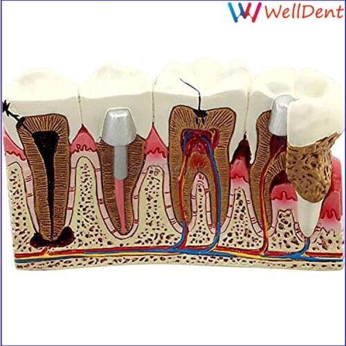 Dental Caries Anatomy Teeth Model Caries Anatomy Tooth Model Teaching&study Dentist Dental Lab