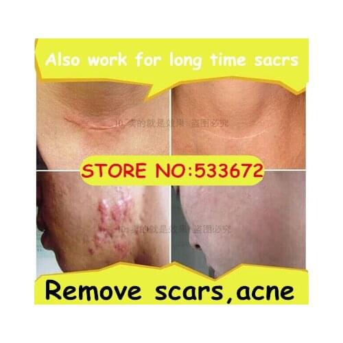 Strong remove scar cream essential oil bumpmaps repair scar Caesarean birth pigment scar traditional chinese medicine
