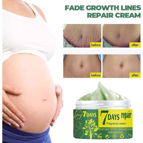 Appti Cream For Stretch Marks