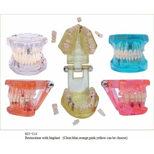 1PC Dental Implant Disease Teeth Model with Restoration Bridge Tooth Dentist for Medical Dentist Training and Teaching Model