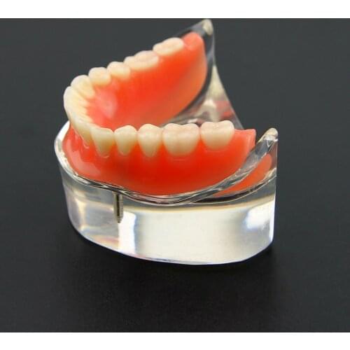 Dental Inferior Overdenture Model Teeth Typodont Lower Jaw Removable 2 Implants