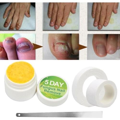 Toe Nail Fungus Treatment Cream Nail Removal Nail Pedicure Repairs Care Tool