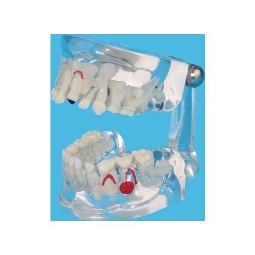 Deciduous Permanent Alternate Model Child tooth development model free shipping