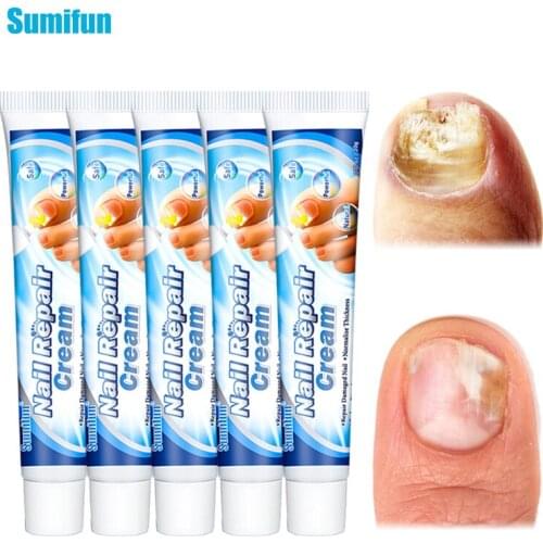 5Pcs Sumifun Onychomycosis Treatment Ointment Fungal Nail Repair Cream Finger Toe Anti Fungus Infection Paronychia