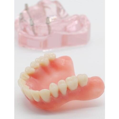 Dentistry Lab Teeth Study Model Overdenture Inferior 4 Implant Demo Model