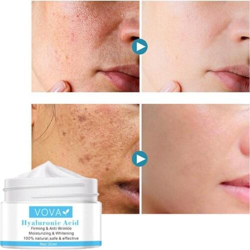 Effective Whitening Freckle Cream Remove Melasma Acne Spot Pigment Melanin Dark Spots Pigmentation Moisturizing Gel Skin Care
